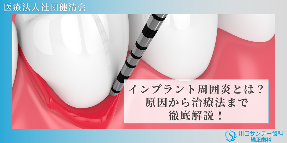 インプラント周囲炎とは？原因から治療法まで徹底解説！